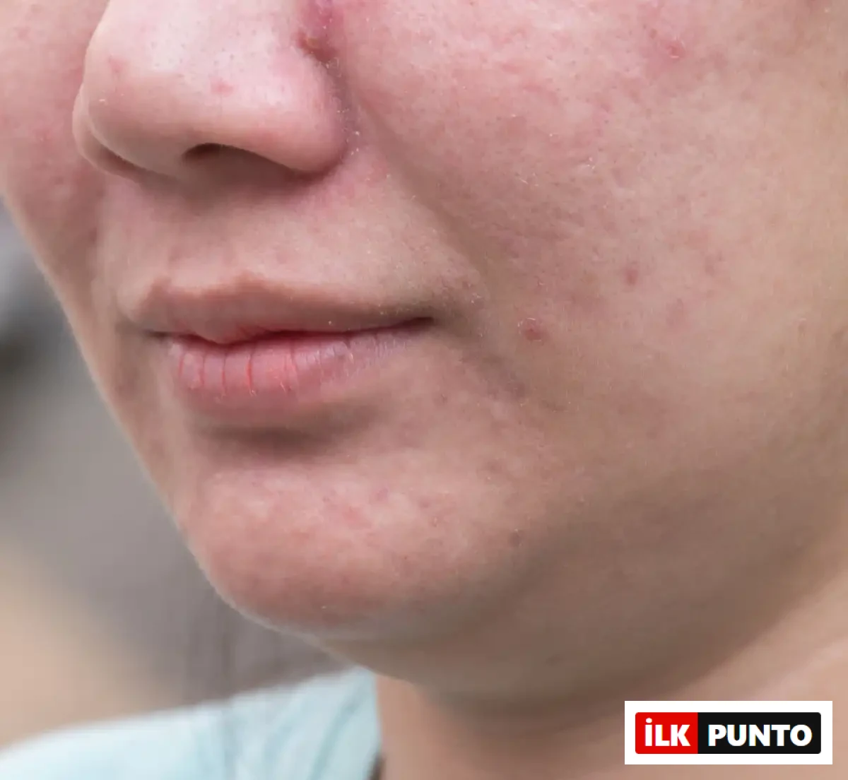 Cilt Lekelerinin Sebepleri